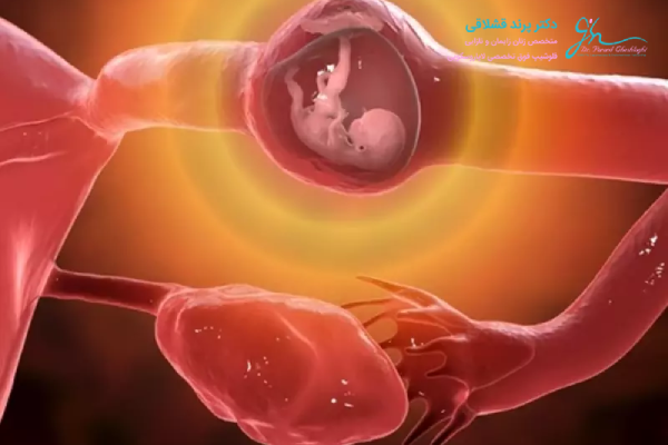 دلایل بارداری خارج از رحم