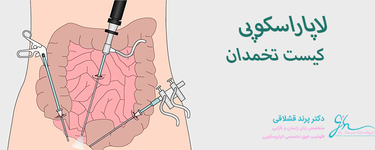 لاپاراسکوپی کیست تخمدان در سعادت آباد