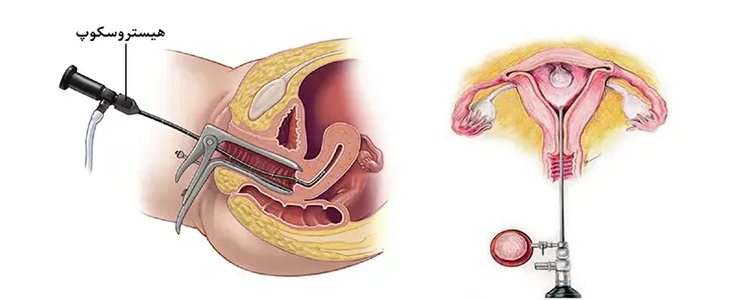 درمان ناباروری با هیستروسکوپی
