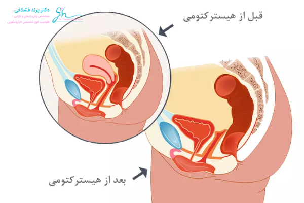 چه افرادی کاندید مناسبی برای هیسترکتومی واژینال هستند؟