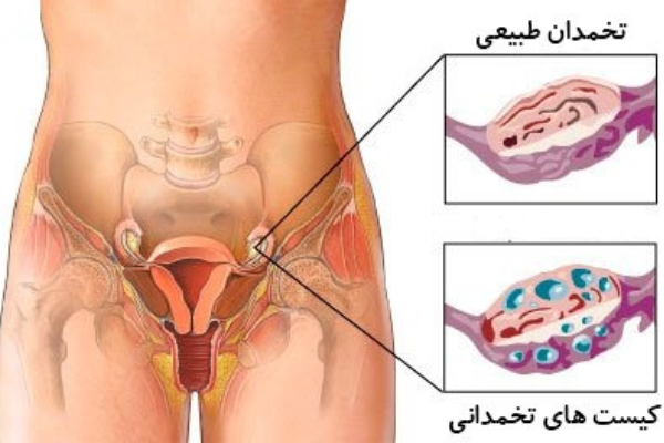بهترین روش های درمان تنبلی تخمدان