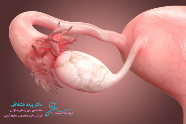 علائم تنبلی تخمدان و چگونه تشخیص داده میشوند؟